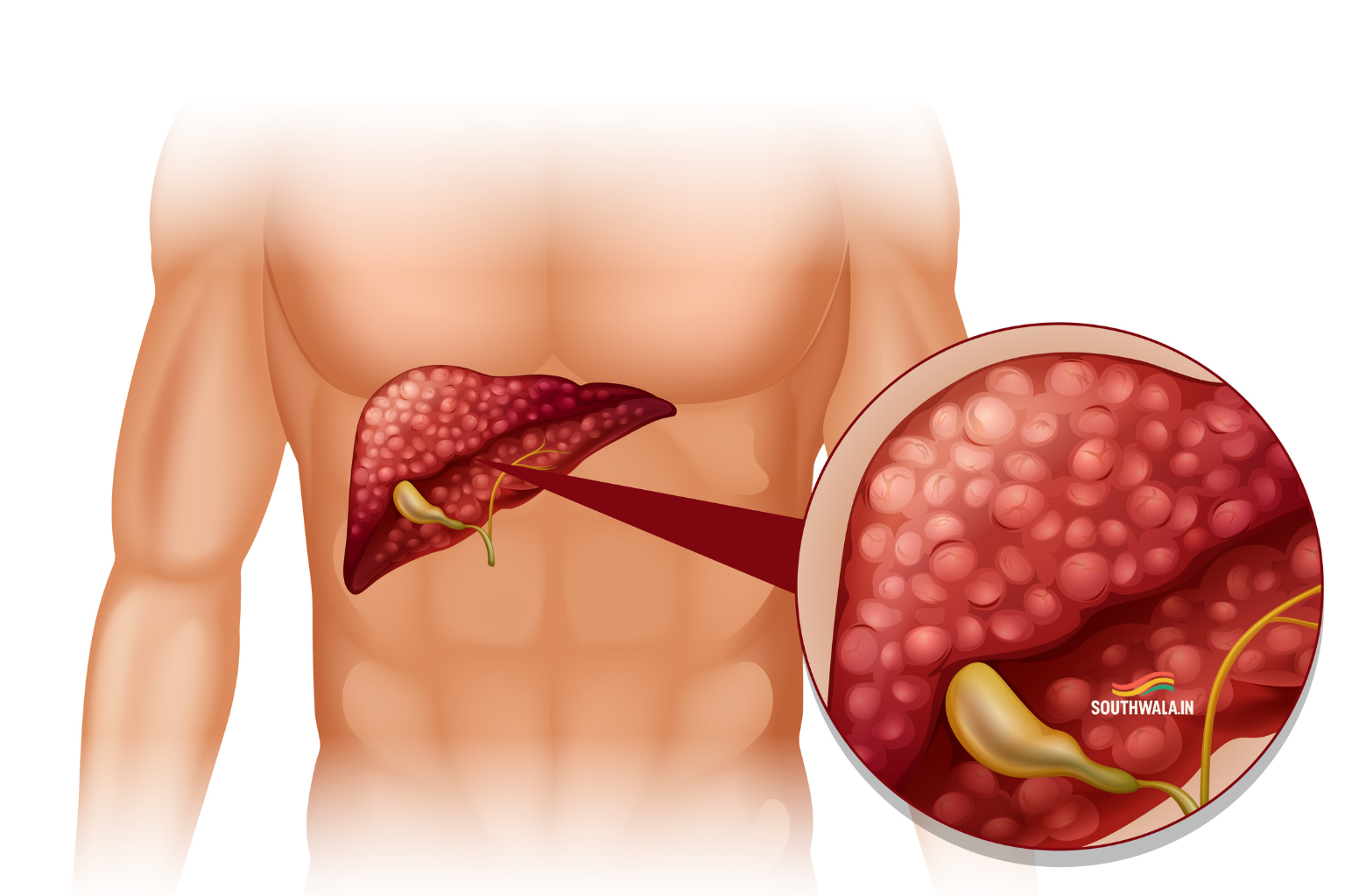 Fatty Liver Symptoms
